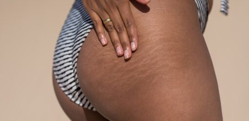 Sprawdzone sposoby na rozstępy