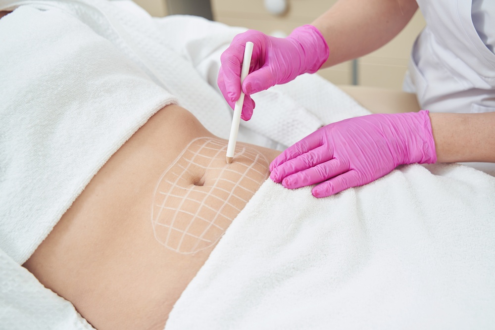 Zaznaczanie obszaru do zabiegu estetycznego Zabieg medycyny estetycznej na brzuchu